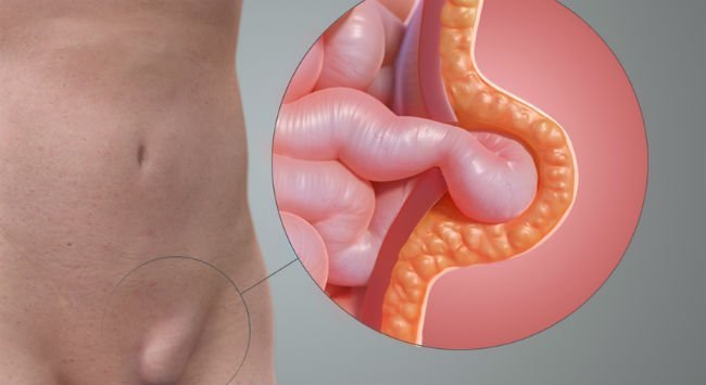 Fiz uma cirurgia de hernia inguinal, será que ainda posso jogar